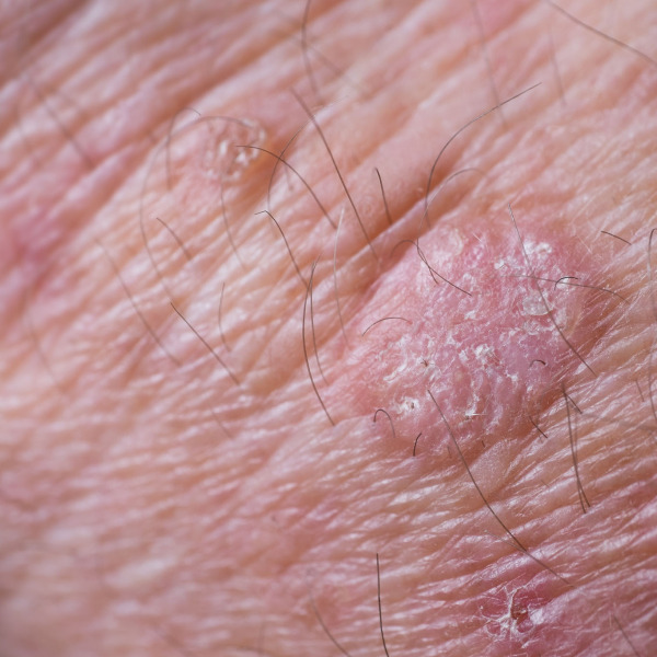 Contact Dermatitis Hand Skin