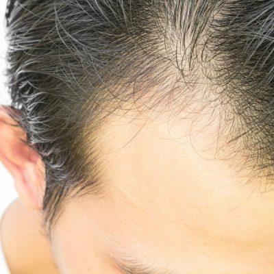 Androgenetic Alopecia Hair Serum On A Man